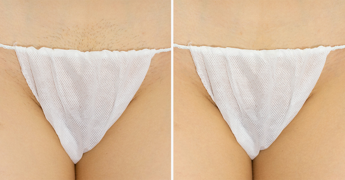Zdjęcie porównawcze przed i po depilacji laserowej bikini.